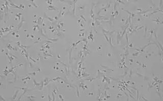 显微镜下胶质母细胞瘤细胞团灭现场   胶质母细胞瘤细胞正在被CAR-T团灭
