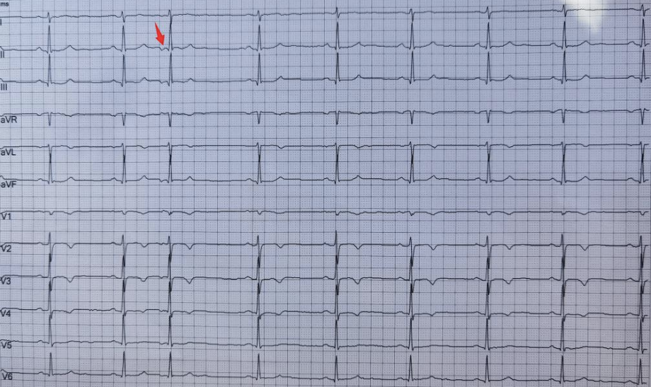 局部呈交界性改变小于10_心电图不会看?这 10 个诊断特征需牢记!