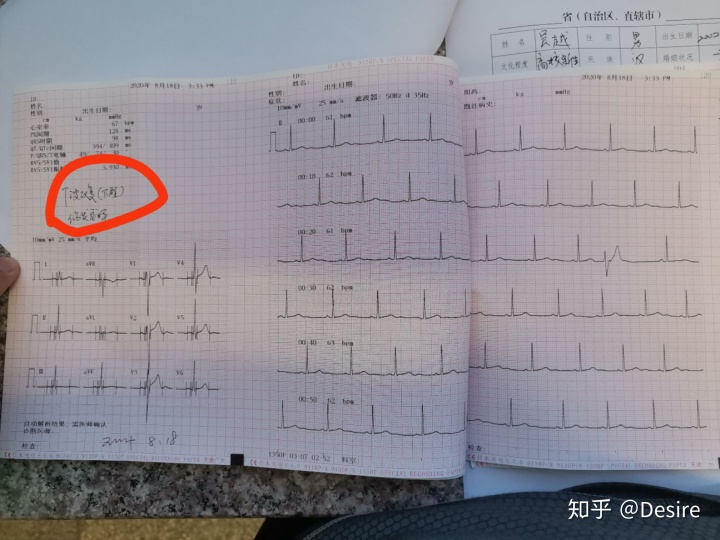 心电图征兵通过小技巧图片