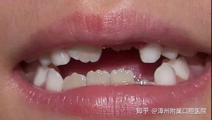 只做两个龅牙门牙孩子新换牙怎么这么丑需不需要做矫正