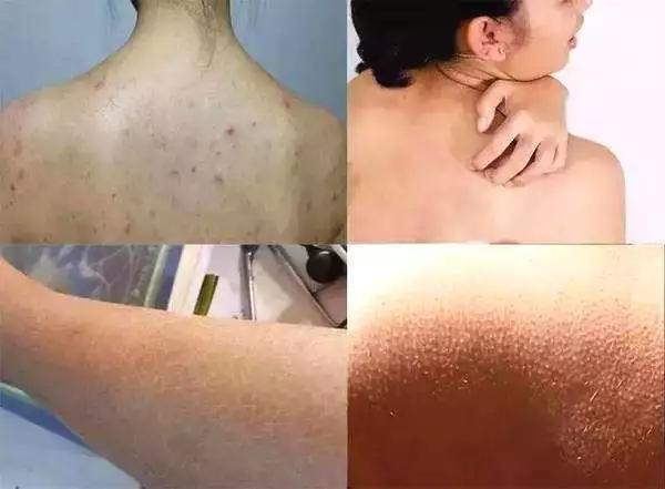 身上皮肤暗黄鸡皮粗糙(身上皮肤暗黄鸡皮粗糙怎么改善)