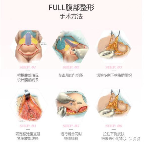 腹壁成形术或"腹部拉皮",是一种为了使腹部更加紧实的美容手术.