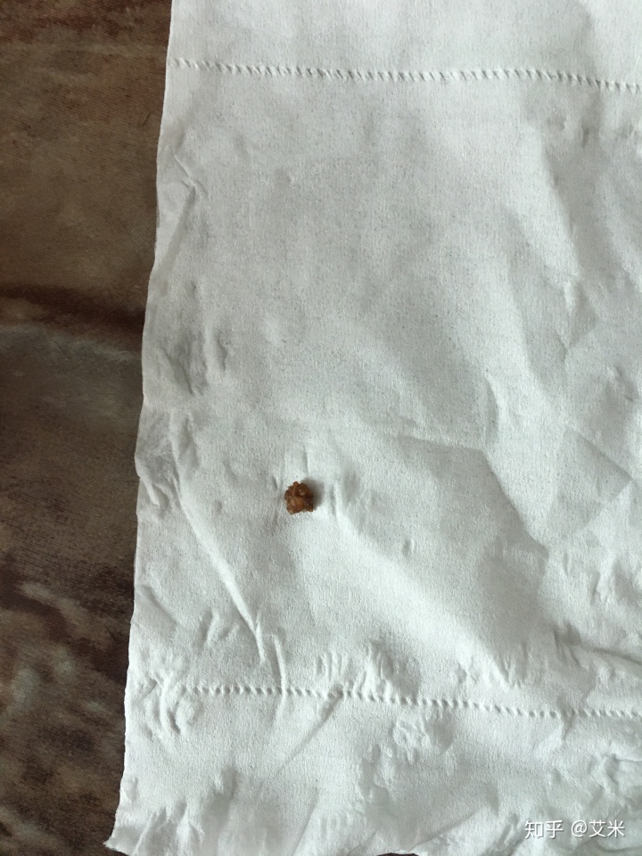 一直跳出来visual六天时间排出来肾结石这种经历再也不要了