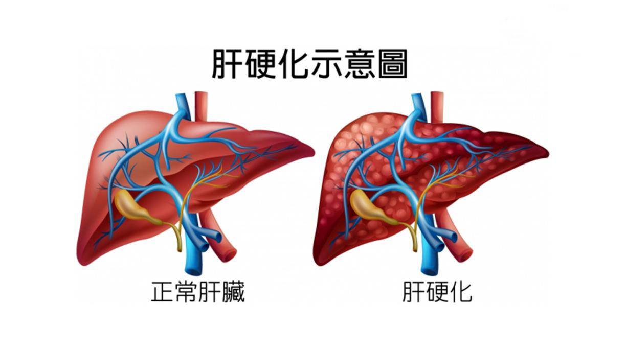 肝硬化解剖图图片