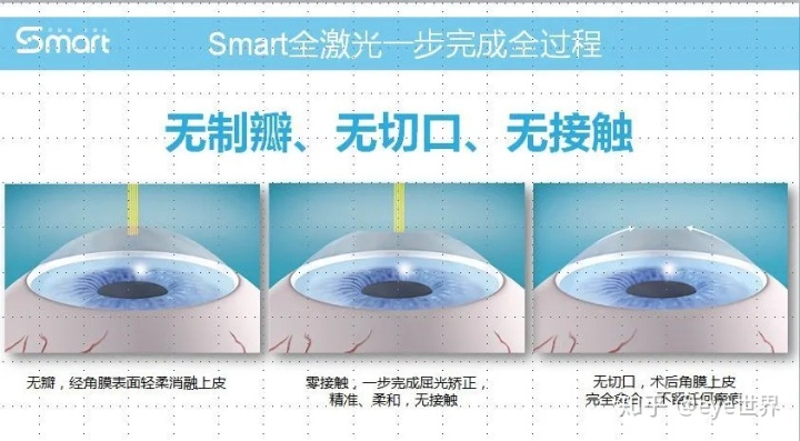 lcl手術和飛秒區別近視手術術式區別iclsmart全飛秒半飛秒