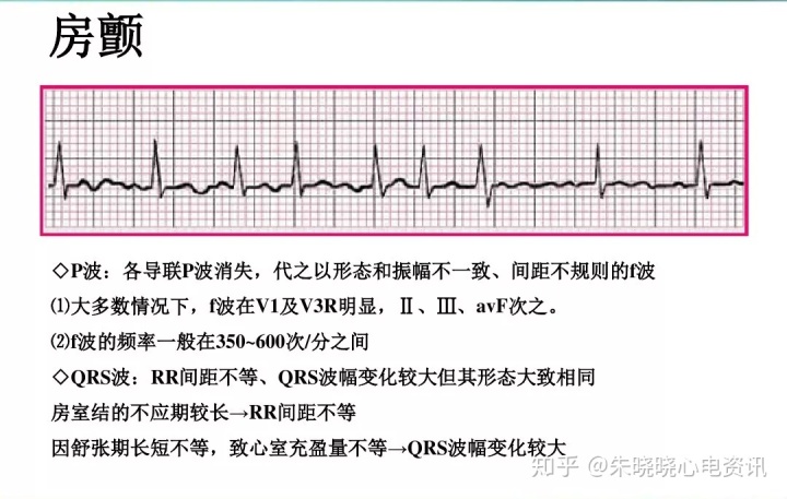 掌握這6項心電圖乾貨波形判斷不再難