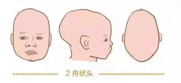 舟状头4岁了智力正常图片