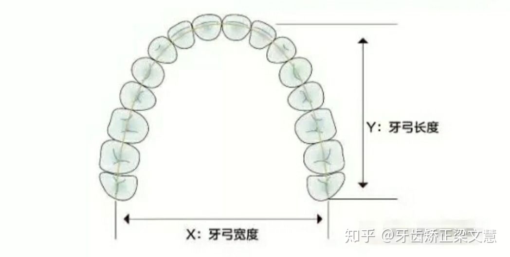 牙齿间隙变大怎么办牙齿矫正扩弓会不会让脸变大适合人群有哪些呢