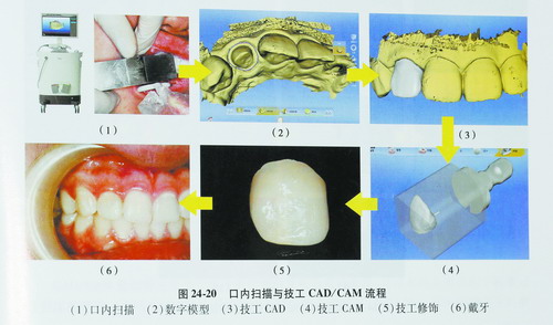 用计算机牙模取模制作戴牙一次搞定患者分不出真牙假牙