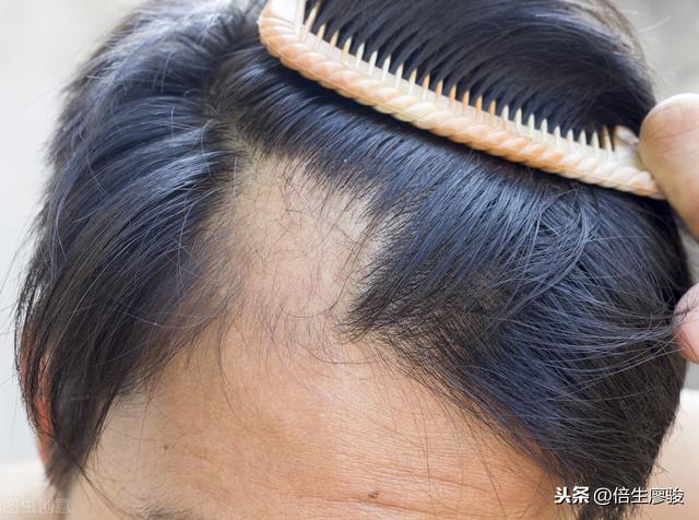 脱发也就是毛囊萎缩,最后不能再生长头发,换句话说,就是前额的毛囊不