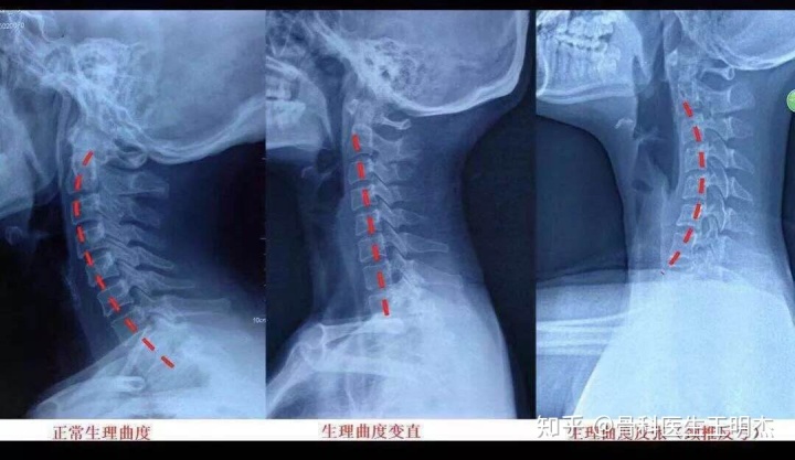 頭部縫了三針屬於什麼傷頸椎為什麼會引起頭暈噁心呢