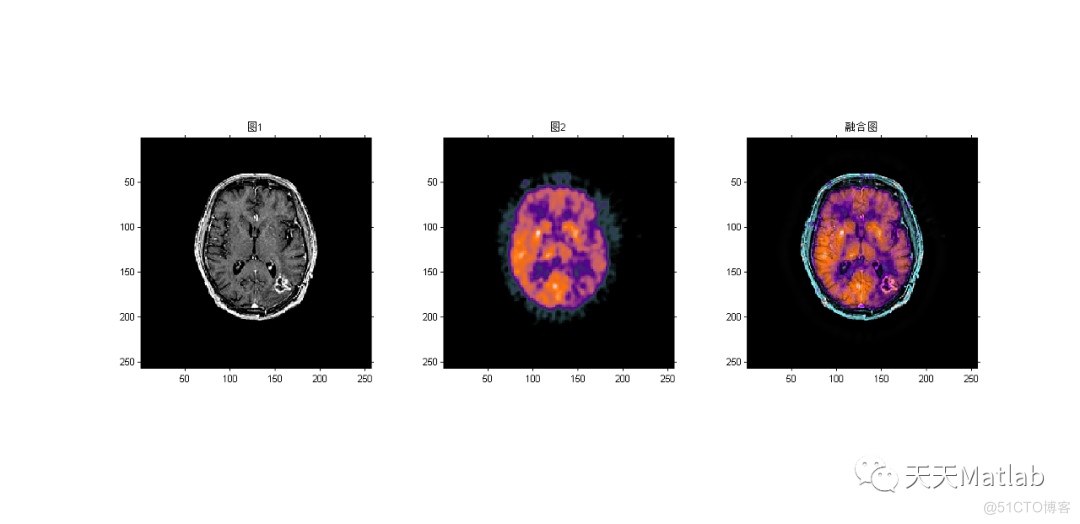 【图像融合】基于NSST结合PCNN实现医学多模态图像融合附matlab代码_模态