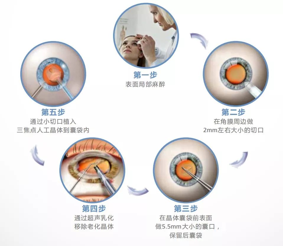 qdialog只有点击才能获得焦点三焦点人工晶体植入术让年近五十的她