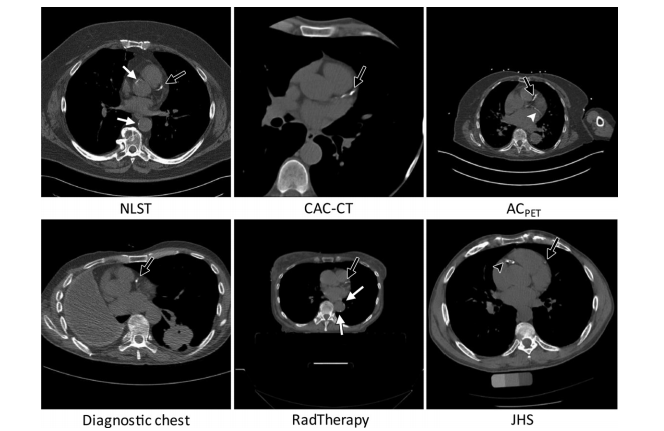 文献速递：深度学习医学影像心脏疾病检测与诊断--CT中的深度学习用于自动钙评分：使用多个心脏CT和胸部CT协议的验证