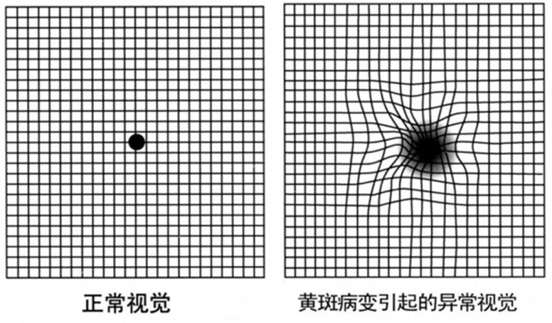 成都爱尔胡建斌院长强调黄斑病变是眼睛哪儿出了问题