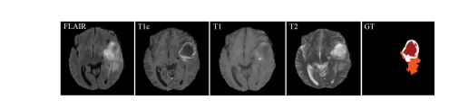 《缺失MRI模态下的脑肿瘤分割的潜在相关表示学习》| 文献速递-深度学习肿瘤自动分割
