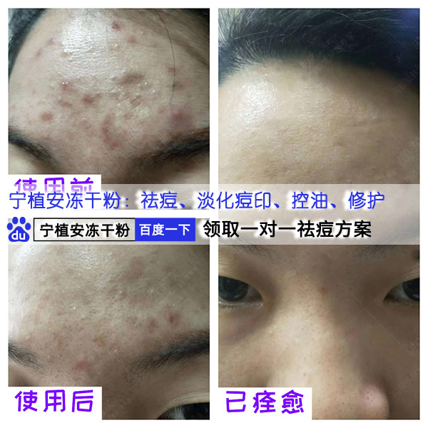 tortoisegit280064bit有什么用油性皮肤用什么祛痘产品男性内分泌失调