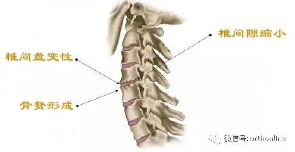 颈椎前路caspar撑开器_“骨质增生”导致的颈椎病怎么破？