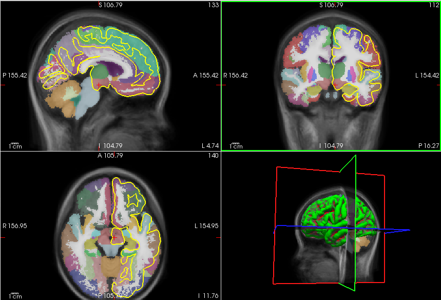 freesurfer制作组平均模板_freesurfer 模板文件-CSDN博客