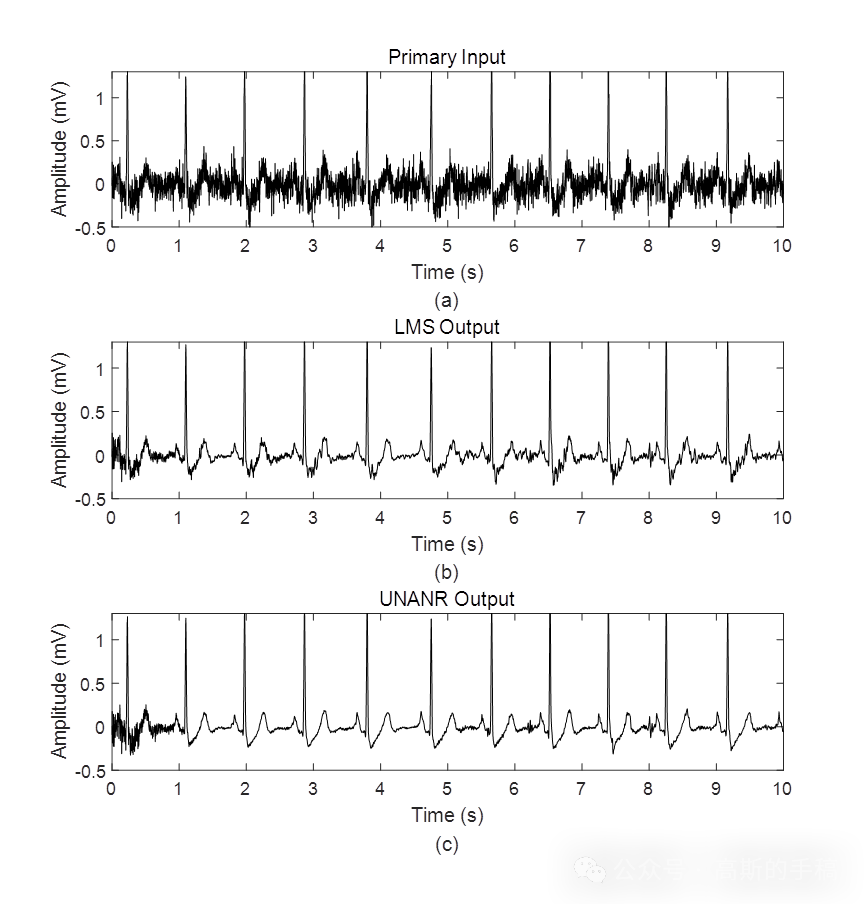 无偏归一化自适应心电ECG信号降噪方法（MATLAB）