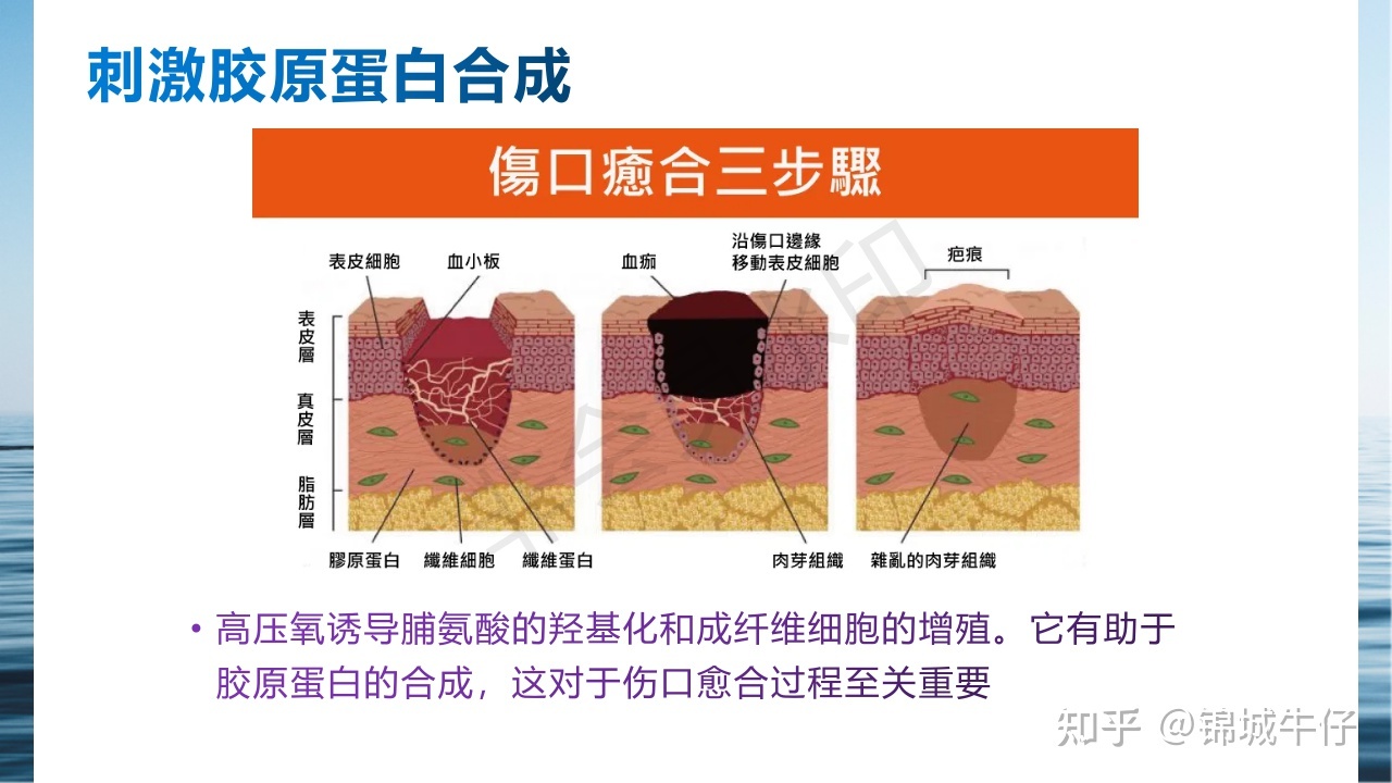 高压氧治疗主要机理