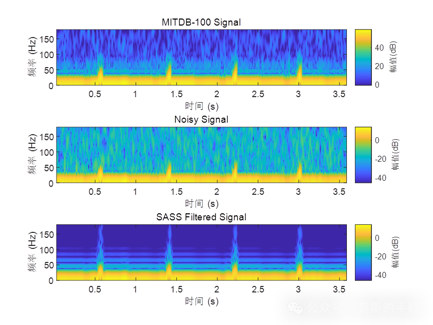 基于稀疏辅助信号平滑的心电信号降噪方法（Matlab R2021B）