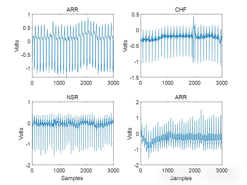 一种最大重叠离散小波包特征提取和支持向量机的ECG心电信号分类方法(MATLAB 2018)
