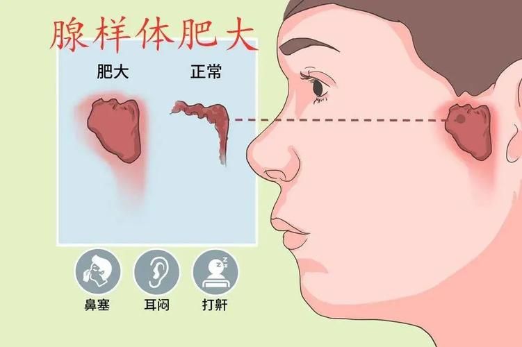 竟然34％的孩子有腺样体肥大，保守还是手术？