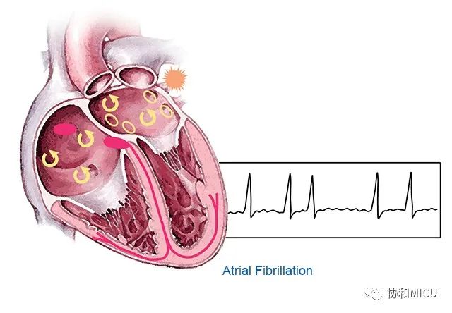 高血压性心脏病和冠状动脉性心脏病(coronary heart disease, chd)是