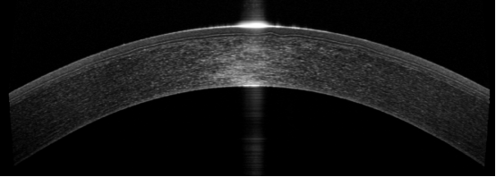 视网膜正常oct图佳能双多模oct影像赏析正常octampocta图像