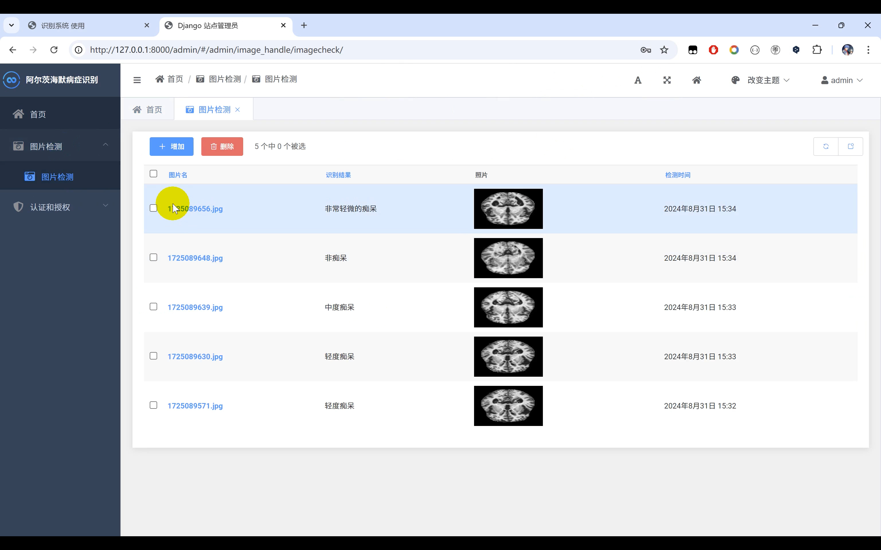 阿尔茨海默病症识别+图像识别Python+人工智能+深度学习+TensorFlow+机器学习+卷积神经网络算法