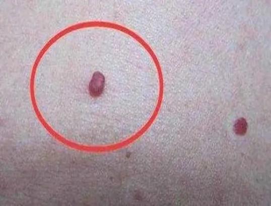 html5小红点身体出现小红点或是这3种原因导致的平时要区分明确