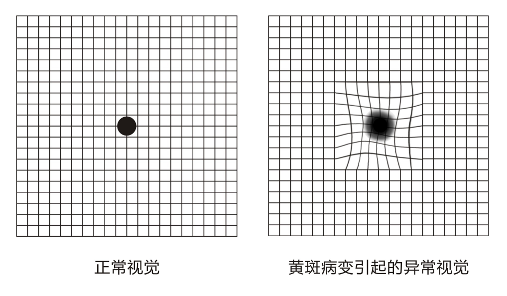 4变形物体警惕视物突然变形还模糊原来眼底生了病