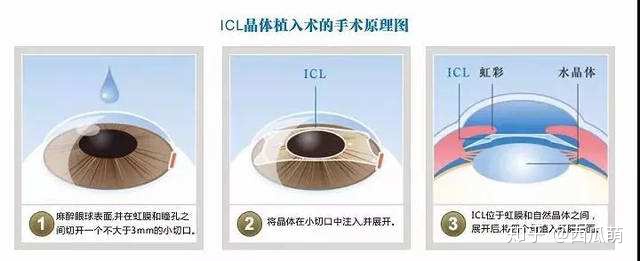 Icd植入是大手术吗 Icl晶体植入术条件你符合吗 Icl手术价格 赵玮龙的博客 Csdn博客