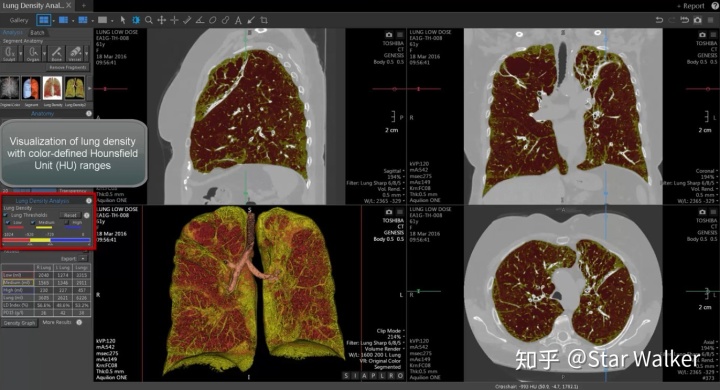 西门子mr图像后处理手册关于影像后处理工作站的点滴分享肺部ct密度