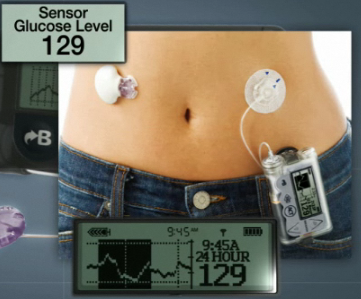 Paradigm Insulin Pump with CGM